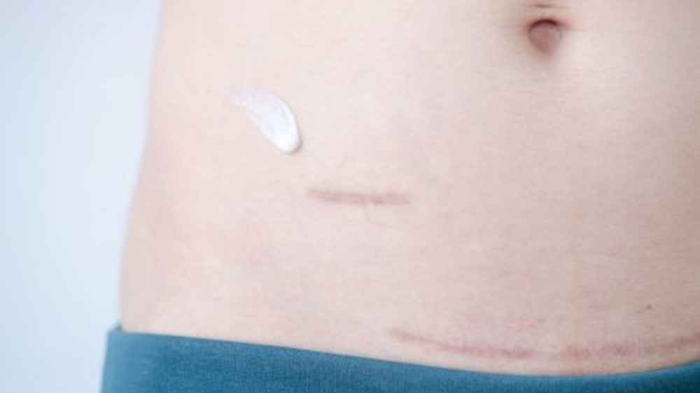 Body scars on person's stomach