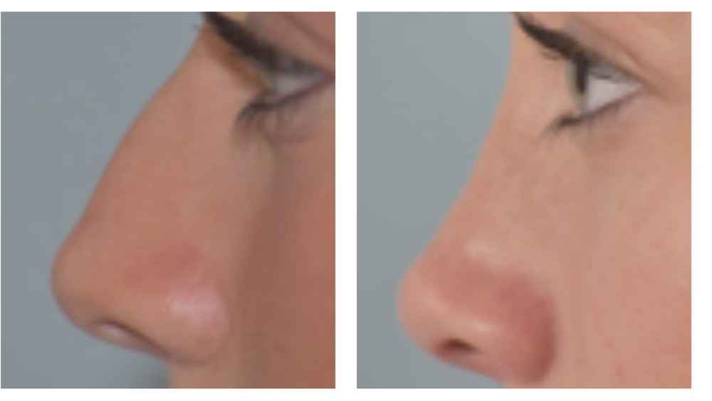 Rhinoplasty before and after photo