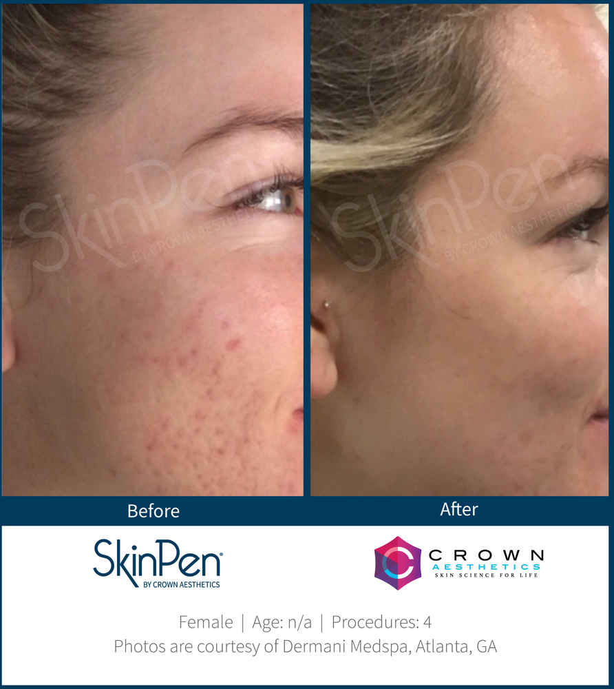 SkinPen Microneedling before and after photo