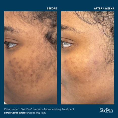 Before and after photos for SkinPen Precision Microneedling Treatment
