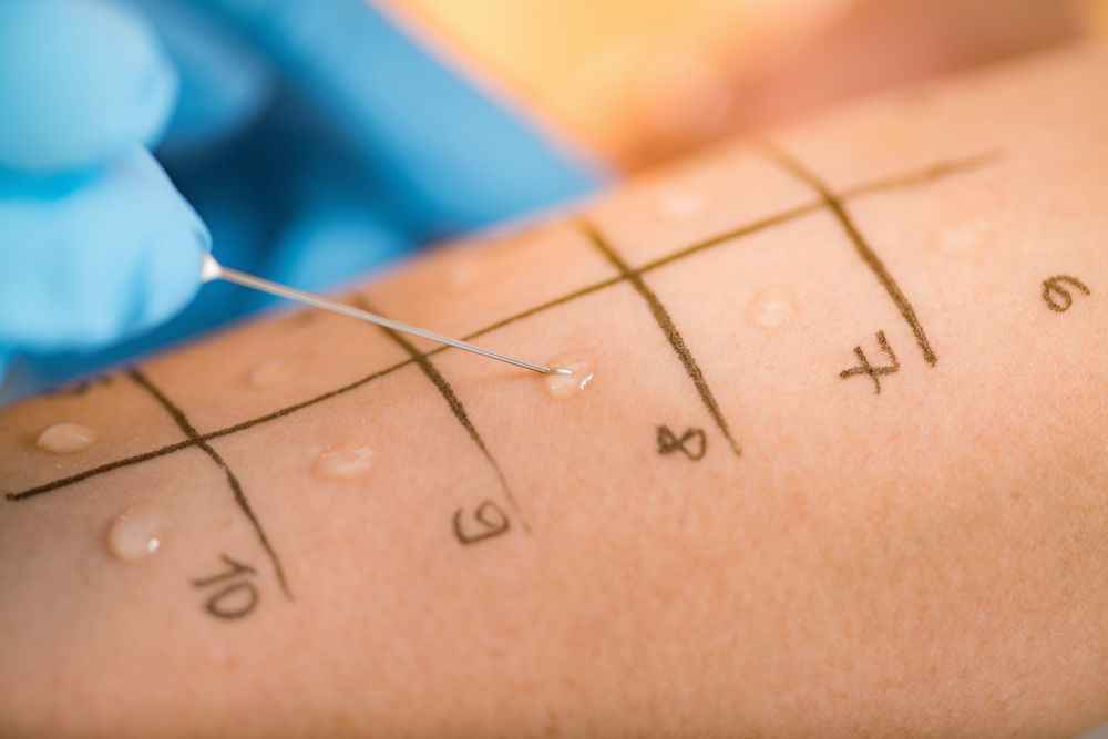 Close up of allergy skin prick test