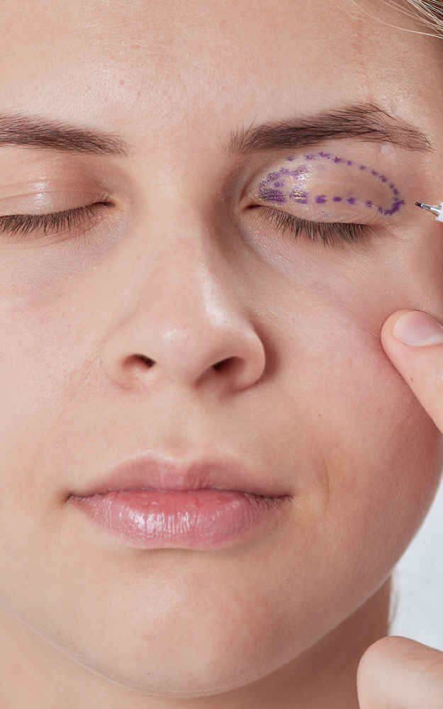 Facial plastic surgeon marking patient before blepharoplasty eyelid surgery