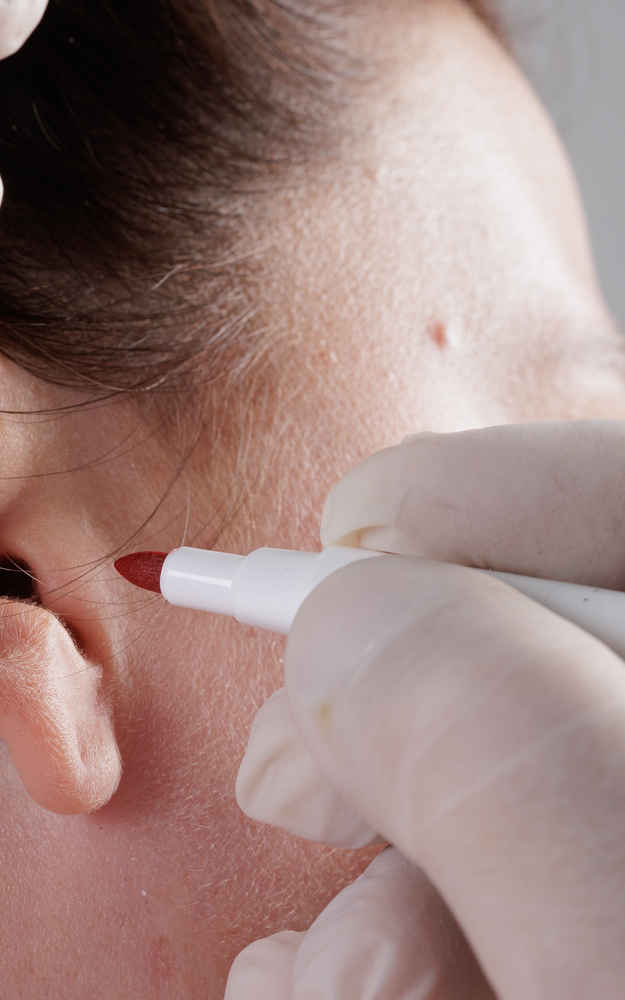 Facial plastic surgeon marking patient before ear lobe repair surgery