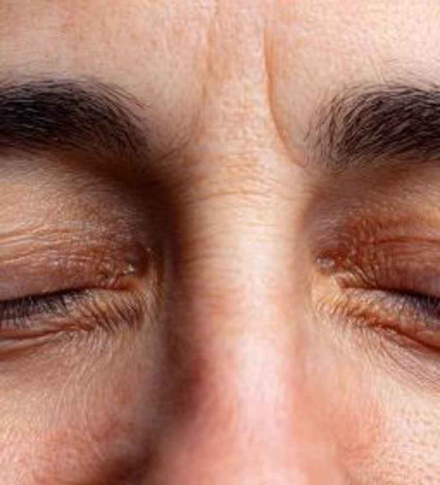 Upper Eyelid Blepharoplasty