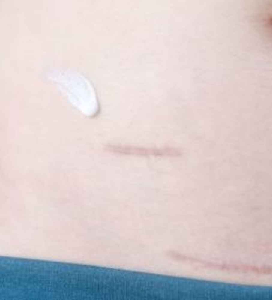 Body Scars