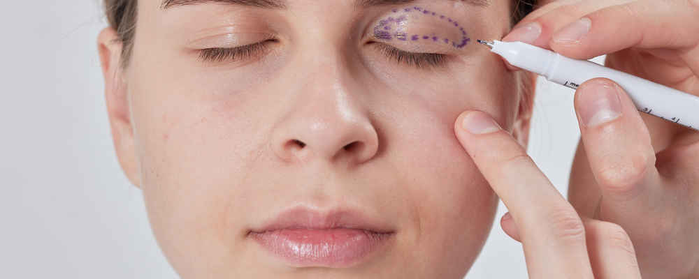 Facial plastic surgeon marking patient before blepharoplasty eyelid surgery