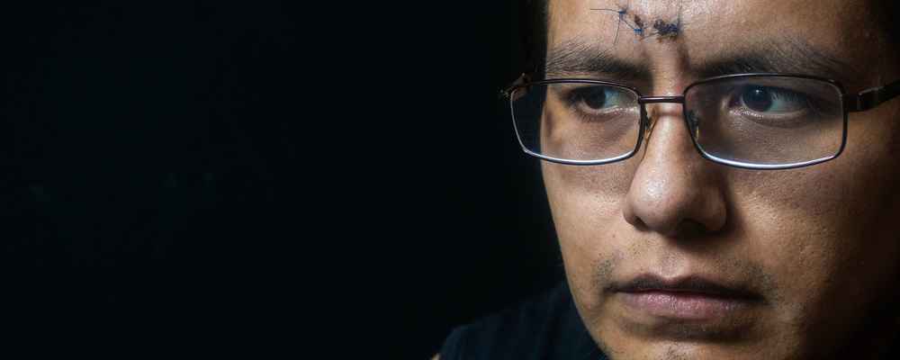 Man before scar revision surgery