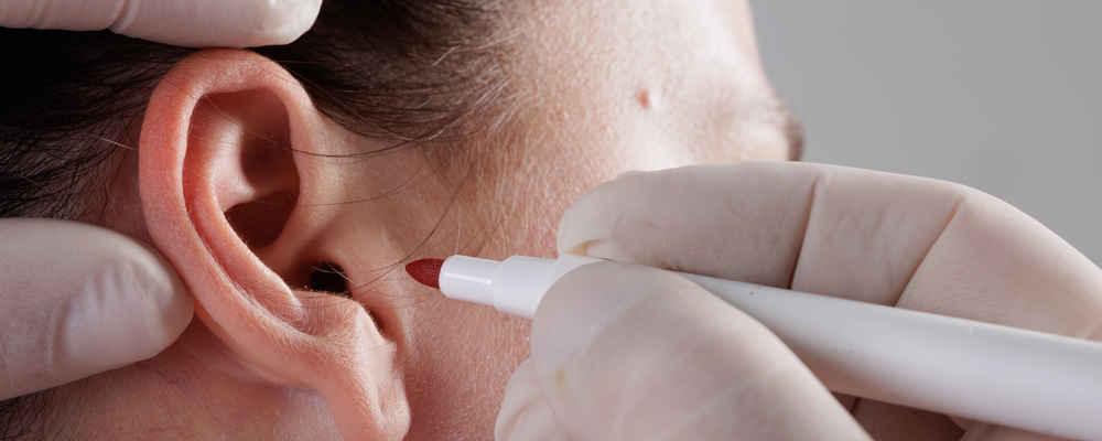 Facial plastic surgeon marking patient before ear lobe repair surgery