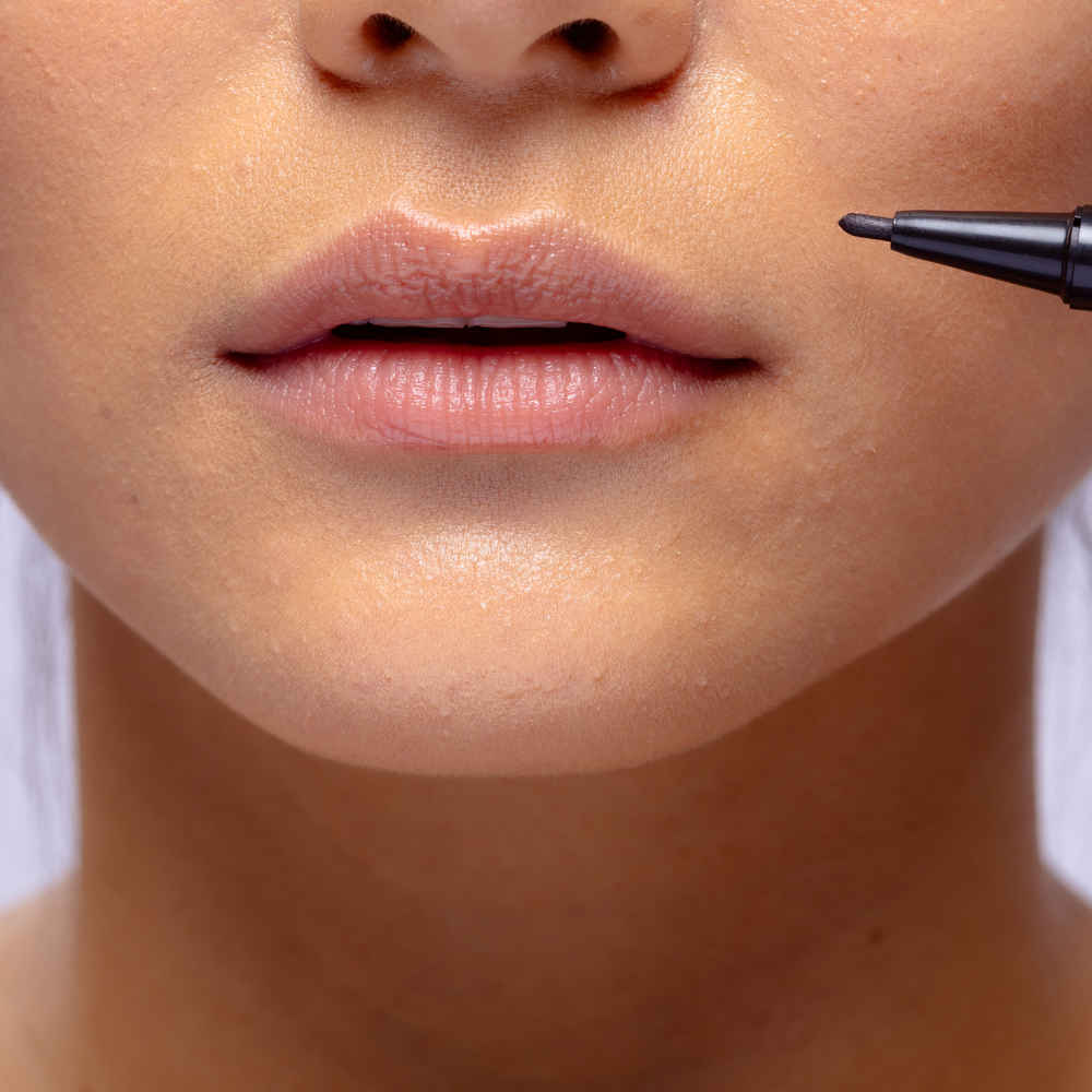 Woman before lip lift surgery