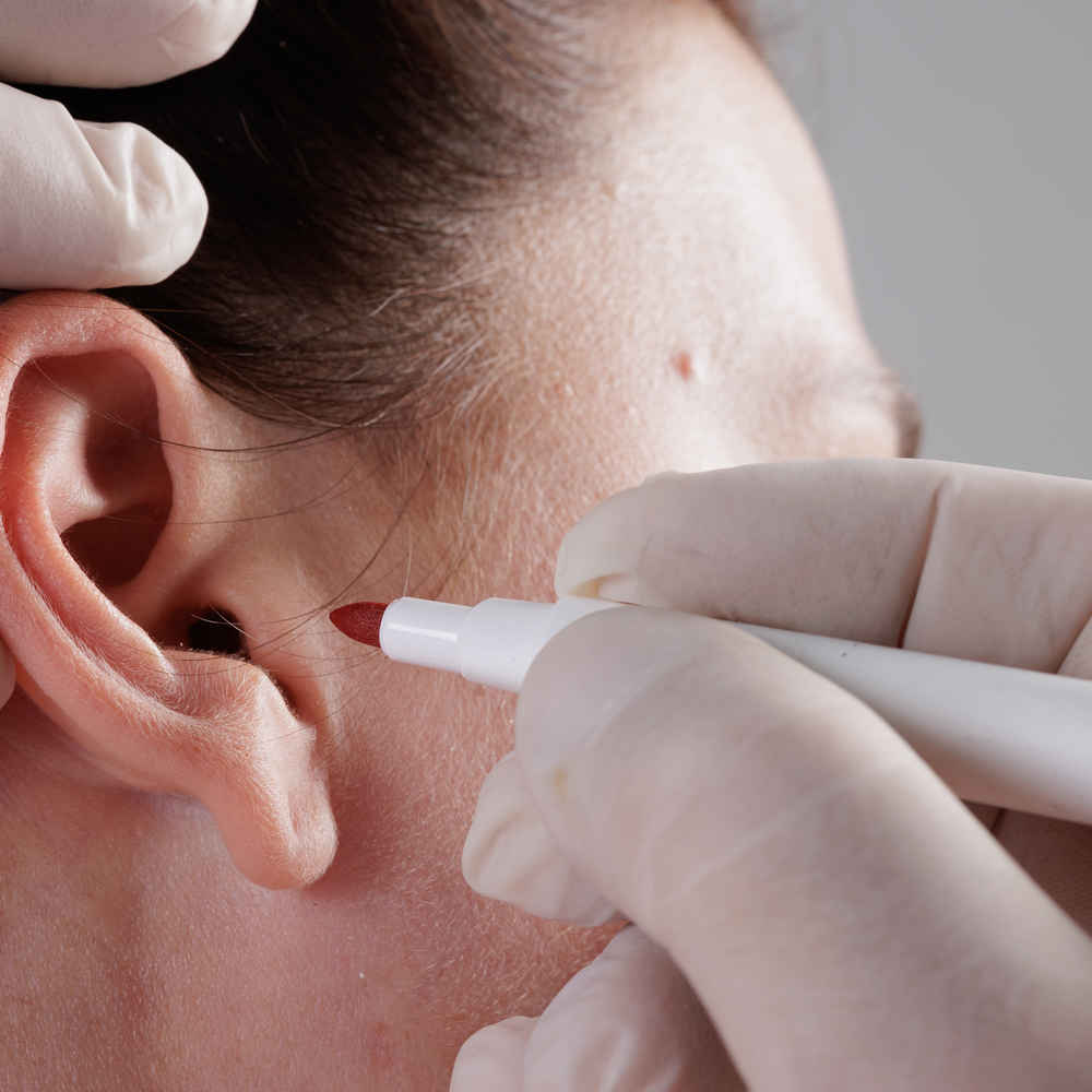 Facial plastic surgeon marking patient before ear lobe repair surgery