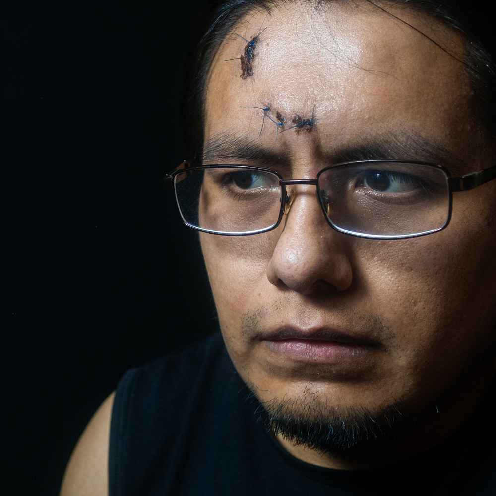 Man before scar revision surgery